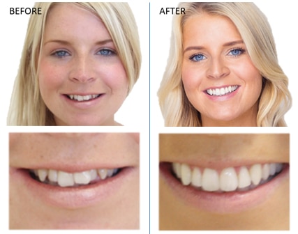 Mikala-invisalign-Before-and-After