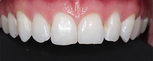 after-bonding-woking-dentist-2
